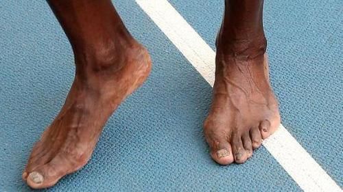 博尔特跟腱断裂了吗（奥运会 跟腱断裂）